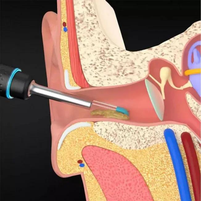 گوش پاک‌کن هوشمند شیائومی BEBIRD مدل M9 Pro image gallery